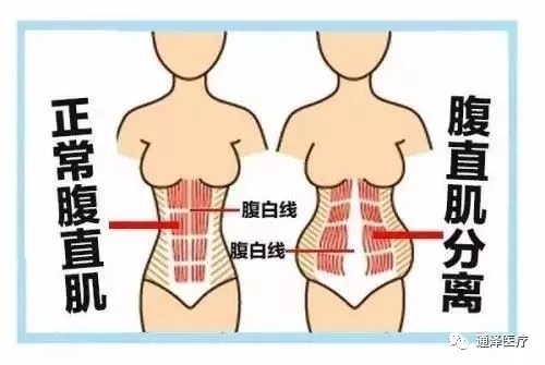 你知道腹直肌分離是什么嗎？