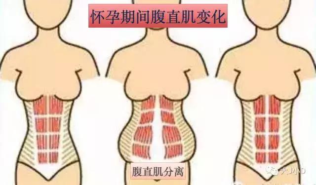 你的腹直肌分離了嗎？