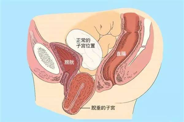 【產(chǎn)后修復(fù)】盆腔臟器脫垂，你有嗎？