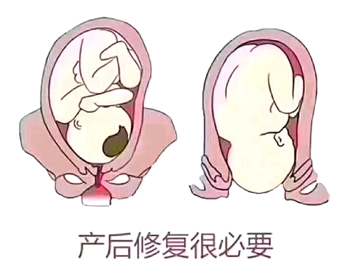 產(chǎn)后恢復(fù)項目好不好，兩大指標尤為關(guān)鍵