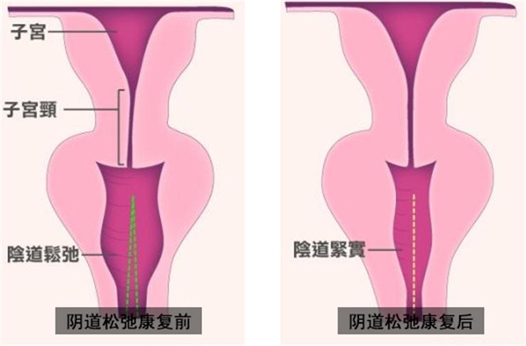 【盆底肌修復(fù)】盆底不修復(fù)，老來后患無窮