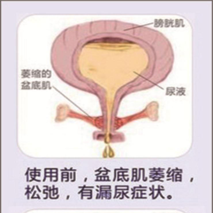 產(chǎn)后盆底肌康復|“社交癌”盯上你了嗎？