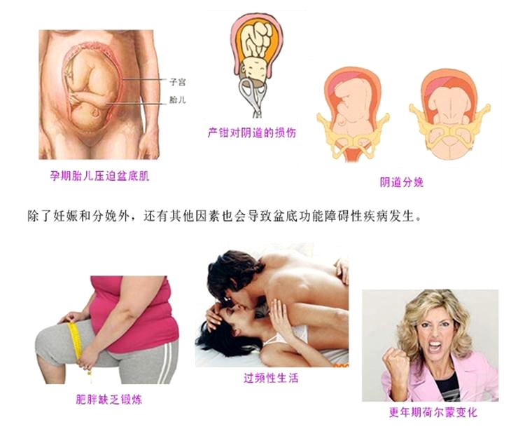 產(chǎn)后康復治療很重要，慢性盆腔痛很重要