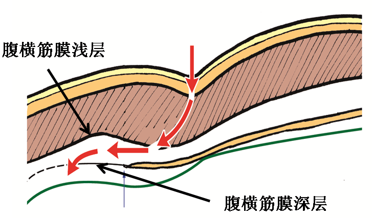 產(chǎn)后腹直肌分離如何康復(fù)，腹直肌修復(fù)那點事