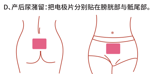 產(chǎn)后康復(fù)治療儀/仿生物電刺激治療產(chǎn)后尿潴留效果怎么樣？