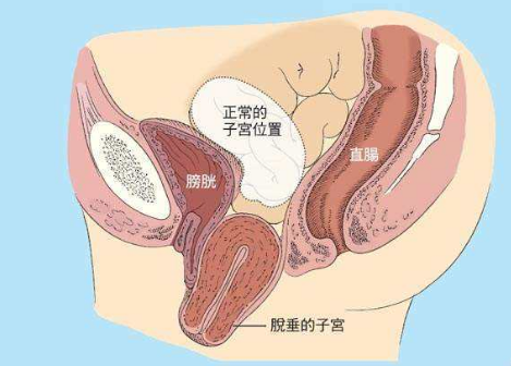 人們常說(shuō)，產(chǎn)后女性做好盆底肌修復(fù)是關(guān)鍵，但盆腔器官的脫垂你也得注意