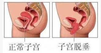 產(chǎn)后恢復(fù)，盆底肌修復(fù)的功能障礙