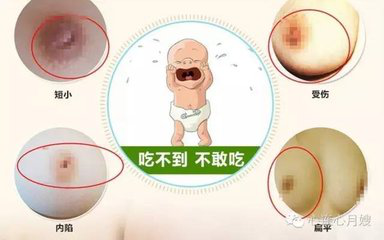產后恢復為什么需要催乳儀器？