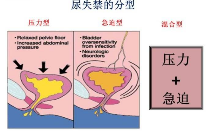 產(chǎn)后盆底肌怎么修復(fù)|尿失禁的類型，傻傻分不清