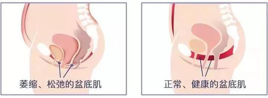 尿失禁治療儀器，不再詢問盆底康復(fù)治療有用嗎這類無意義問題