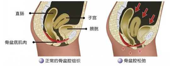 盆底功能檢測很重要，盆底肌松弛了會(huì)有什么表現(xiàn)呢？