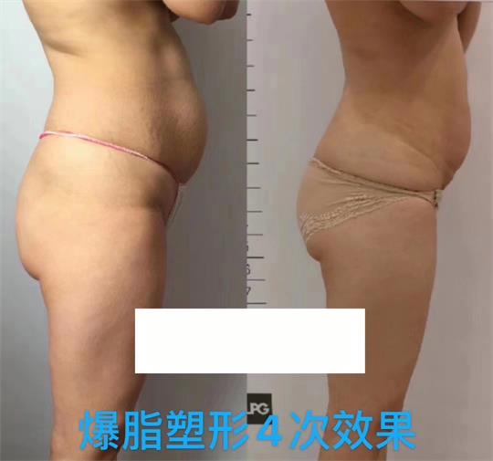 產(chǎn)后塑形美雕儀，生完孩子真的很難恢復(fù)身材？未必……