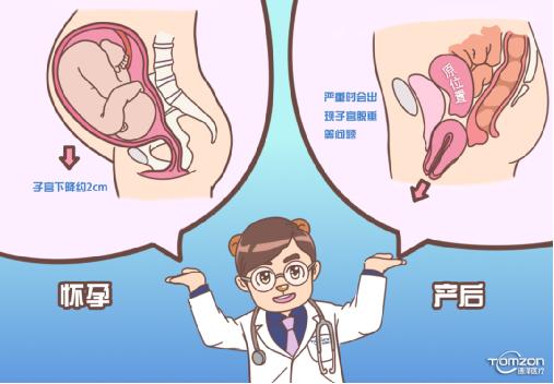 盆底康復(fù)治療儀可以解決子宮下降問題嗎？