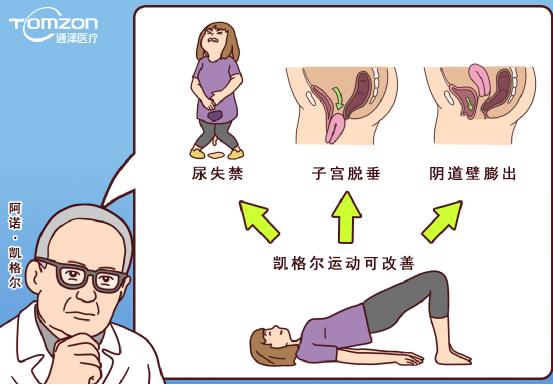 使用凱格爾球還能做盆底治療儀嗎？