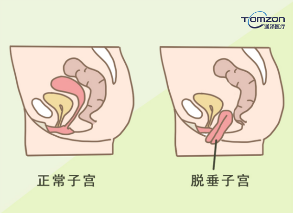 盆底康復治療儀能夠改善什么樣的情況？